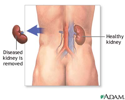 kidney-removal